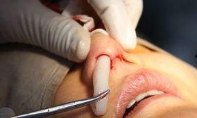 假体隆鼻视频全过程视频,假体隆鼻手术全过程