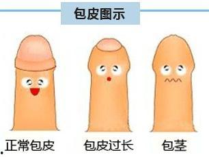 包皮手术拆线视频,轻松掌握术后恢复技巧