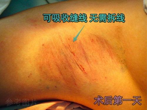 腋臭手术全过程视频,从术前准备到术后恢复